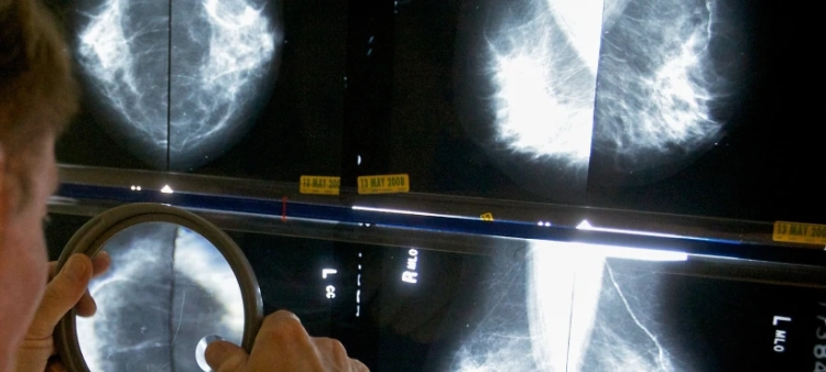 Impacto del Covid-19 en la supervivencia de pacientes con cáncer