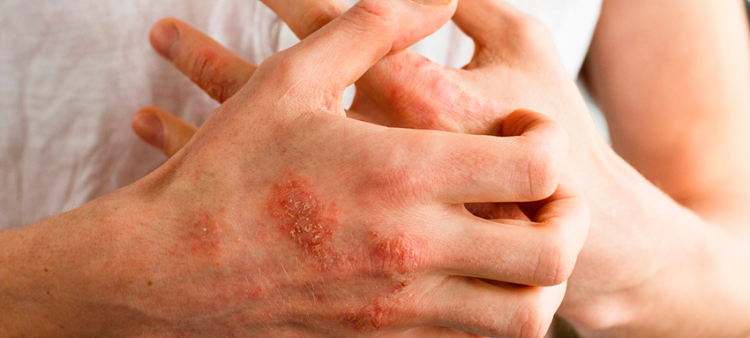 Consejos para prevenir la dermatitis atópica