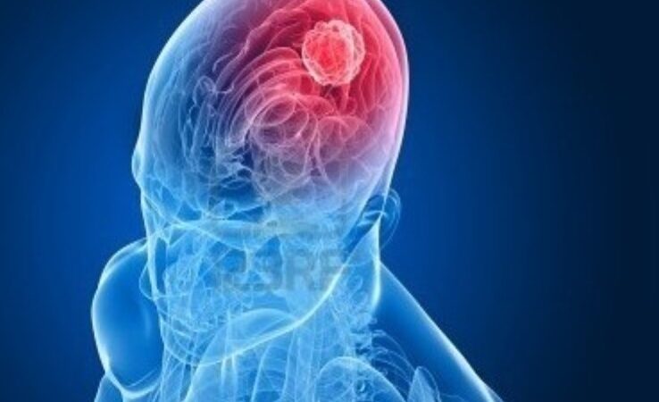 Señales invisibles del cáncer de cabeza y cuello que no debes ignorar