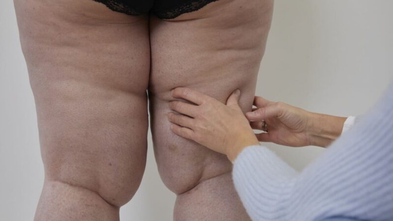 La lucha silenciosa contra el lipedema: una enfermedad que se confunde con la obesidad