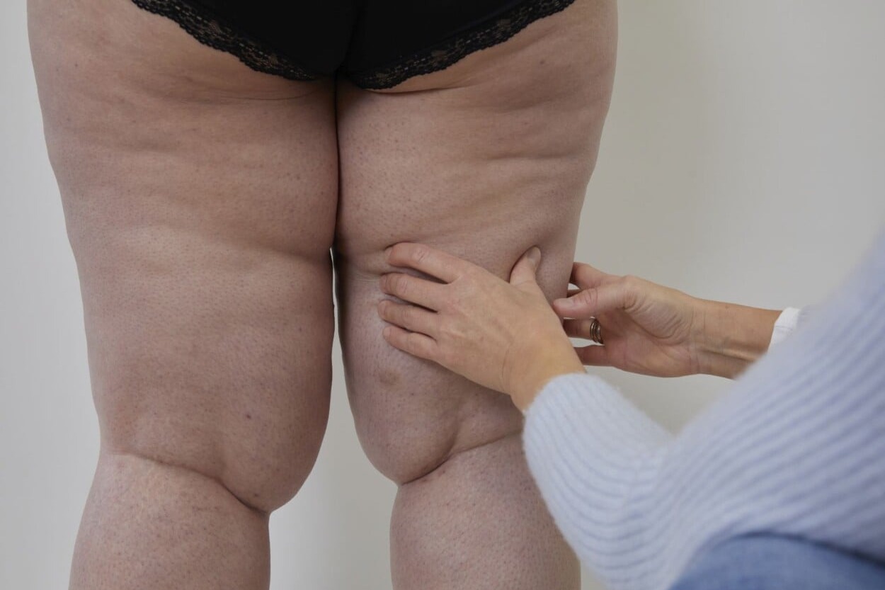 La lucha silenciosa contra el lipedema: una enfermedad que se confunde con la obesidad