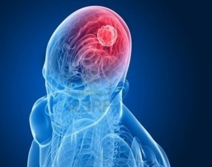 Señales invisibles del cáncer de cabeza y cuello que no debes ignorar