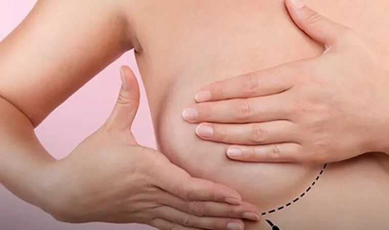 Descubren células híbridas responsables del cáncer de mama
