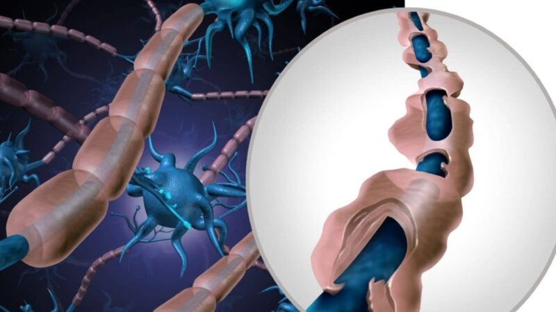 Tratamientos diversos para la esclerosis múltiple, una enfermedad sin cura