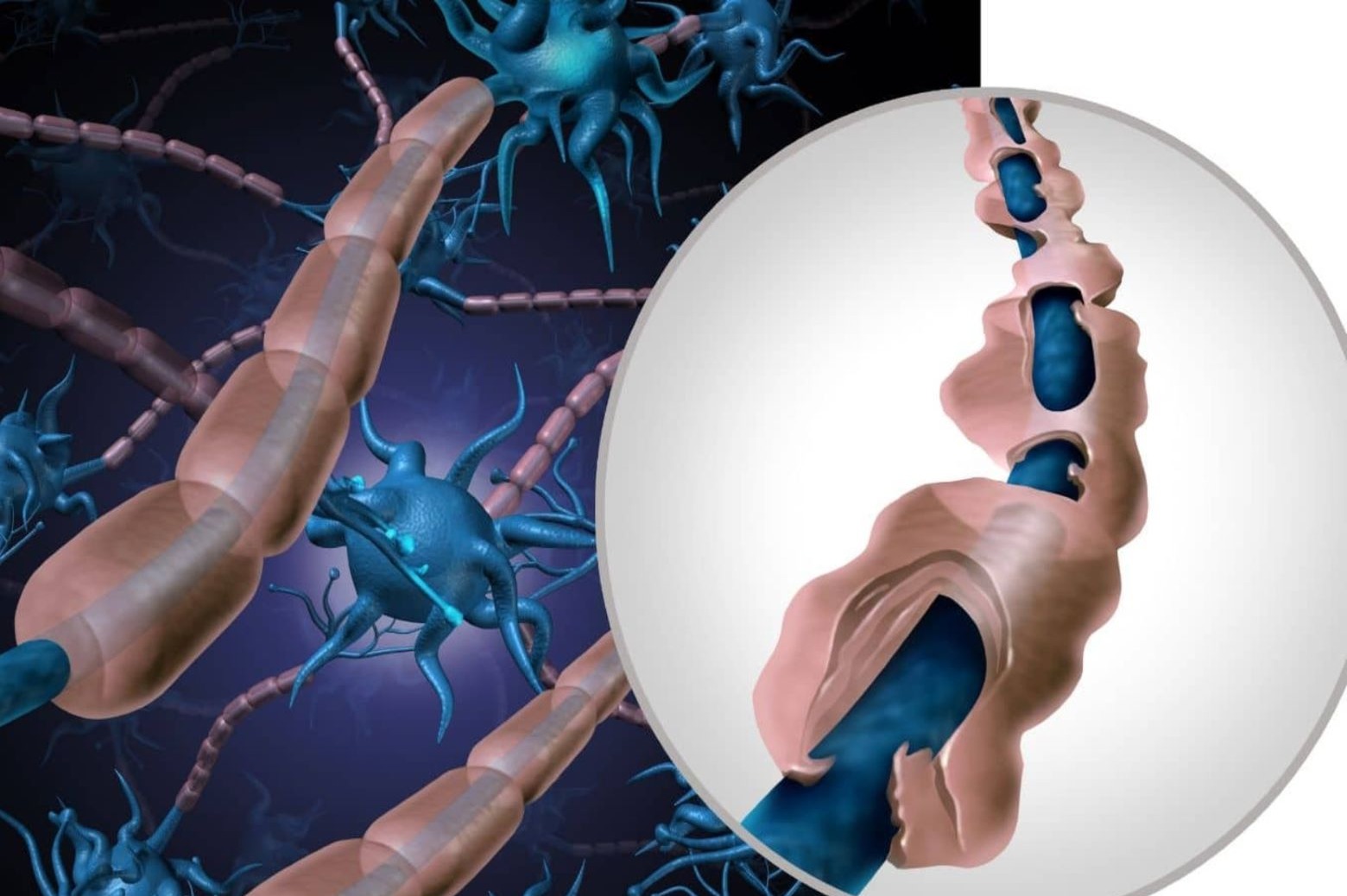 Tratamientos diversos para la esclerosis múltiple, una enfermedad sin cura