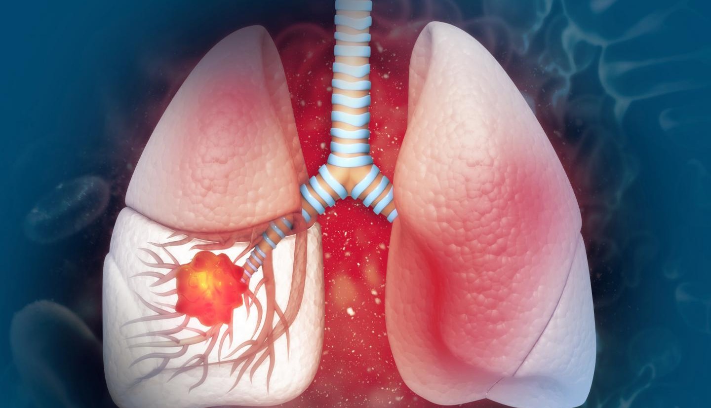 El tabaquismo, principal causante del cáncer de pulmón en el país