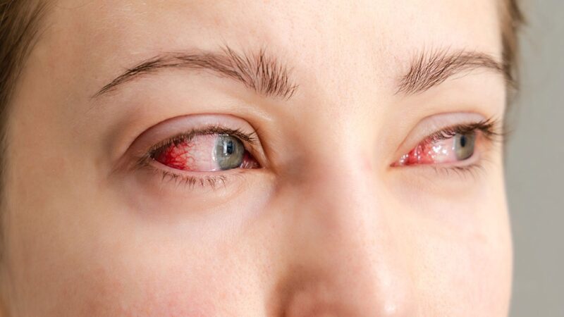 Polvo del Sahara Aumenta Riesgo de Irritación Ocular en República Dominicana