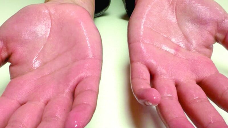 Hiperhidrosis en manos y pies: más que un simple exceso de sudoración