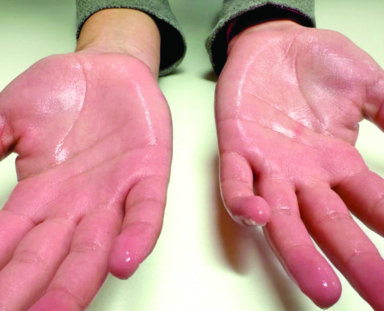 Hiperhidrosis en manos y pies: más que un simple exceso de sudoración