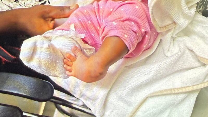 Hospital Hugo Mendoza Transforma Vidas: 1,000 Niños Atendidos en Programa de Pie Equinovaro