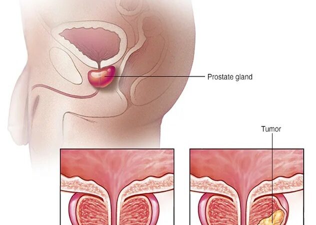 Revolucionaria Prueba Sueca Promete Mejorar la Detección del Cáncer de Próstata