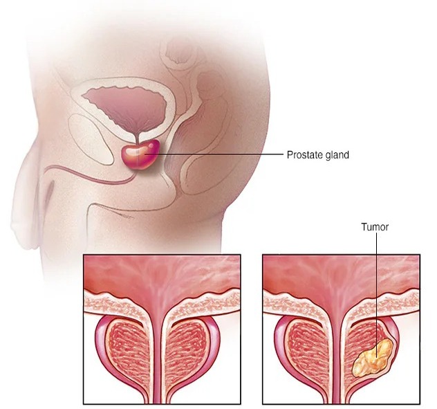 Revolucionaria Prueba Sueca Promete Mejorar la Detección del Cáncer de Próstata