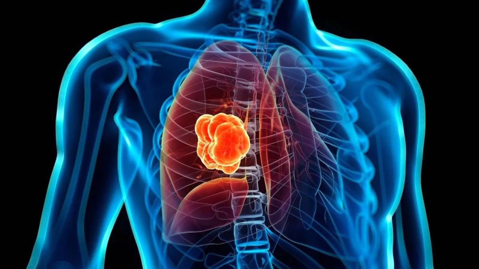 Innovador Tratamiento Sin Quimioterapia Revoluciona la Lucha Contra el Cáncer de Pulmón