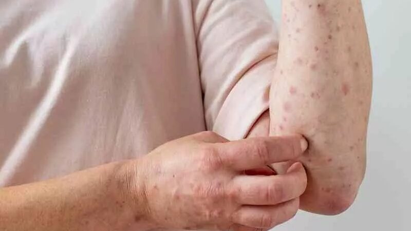 Salud Pública Garantiza Control de Viruela Símica en San Cristóbal
