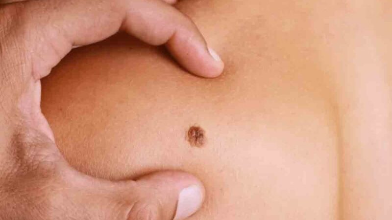 Salud Pública Insta a la Detección Temprana del Sarcoma en República Dominicana