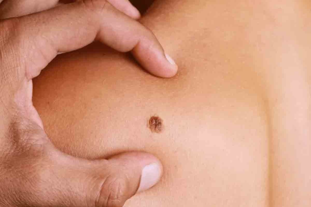 Salud Pública Insta a la Detección Temprana del Sarcoma en República Dominicana