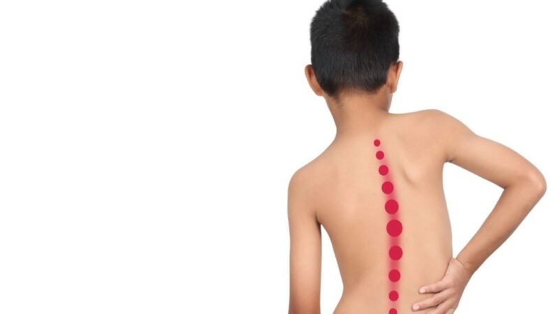 Detectar la Escoliosis a Tiempo: Consejos Clave para Padres