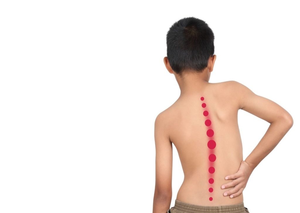 Detectar la Escoliosis a Tiempo: Consejos Clave para Padres