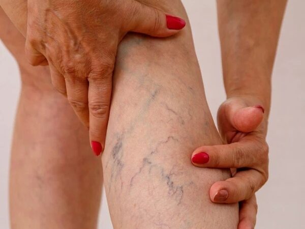 Proponen Incluir Tratamiento de Varices con Láser en el Plan de Salud