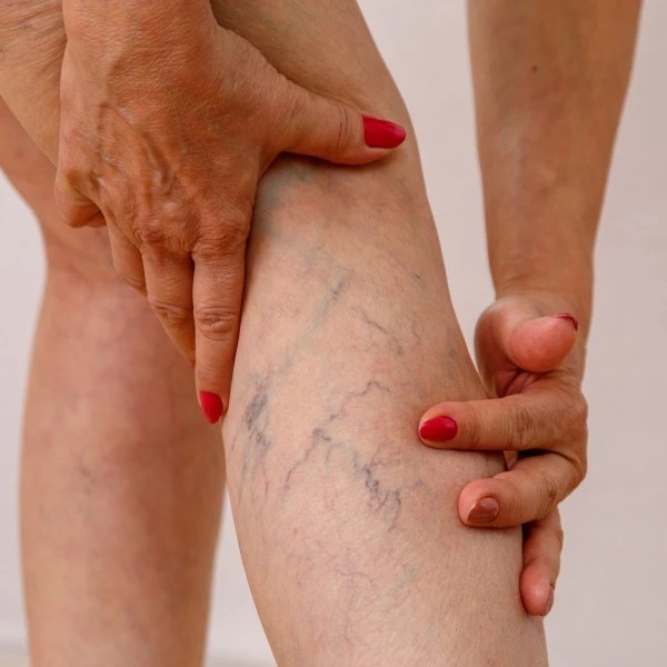 Proponen Incluir Tratamiento de Varices con Láser en el Plan de Salud