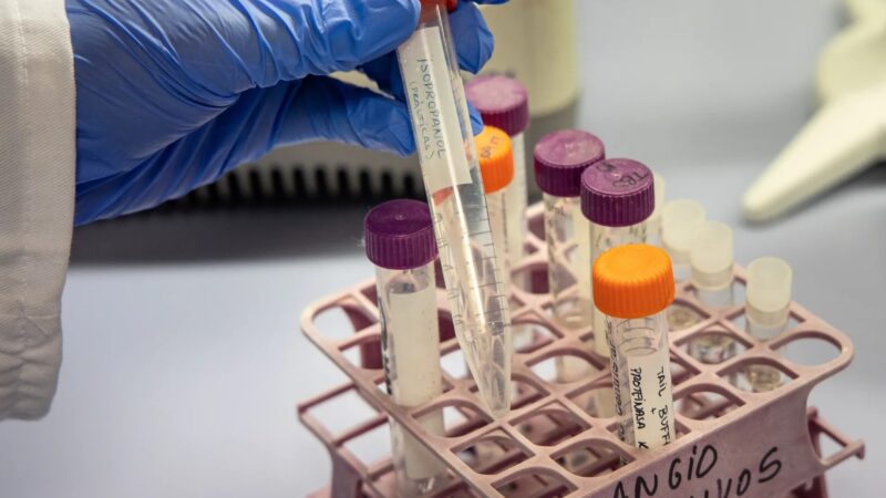 Innovadora Terapia Génica Busca Prevenir el Alzhéimer