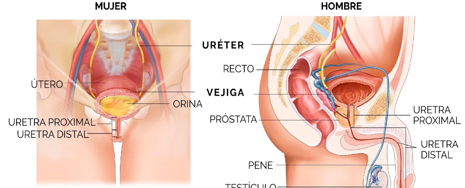 Impacto de la Estrechez Uretral en la Calidad de Vida de los Pacientes