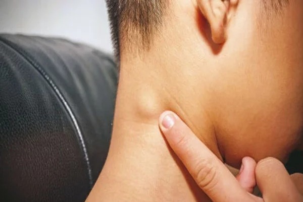 Ganglios Inflamados: Cuándo Preocuparse y Cuándo No