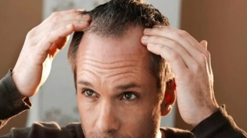 La Calvicie: Un Camino que No Siempre Conduce a la Pérdida Total del Cabello