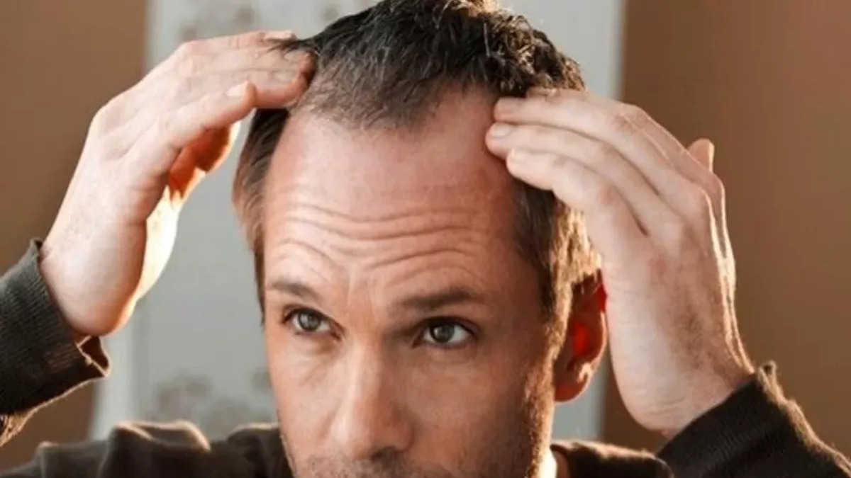 La Calvicie: Un Camino que No Siempre Conduce a la Pérdida Total del Cabello