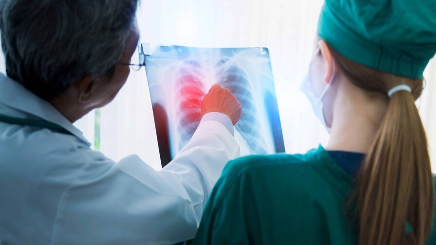Detección Temprana: Clave en la Lucha contra el Cáncer de Pulmón